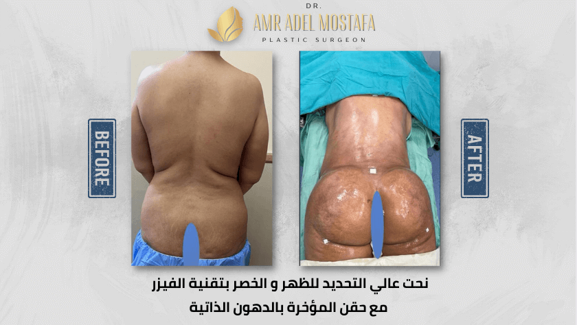 حقن-المؤخرة-بالدهون-الذاتية