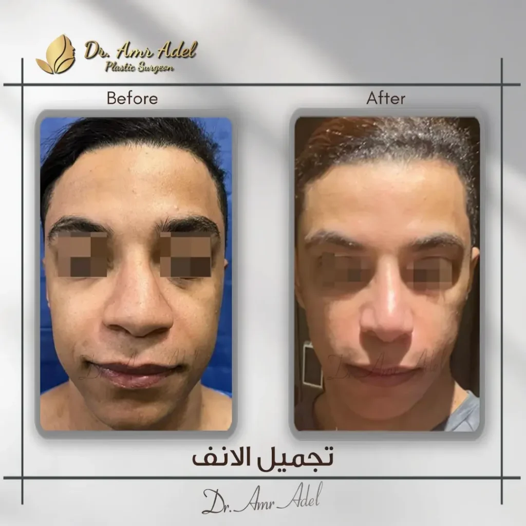 نجاح-عملية-تجميل-انف