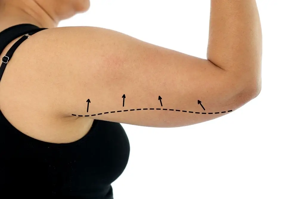 نحت-وشد-الذراع-بالفيزر