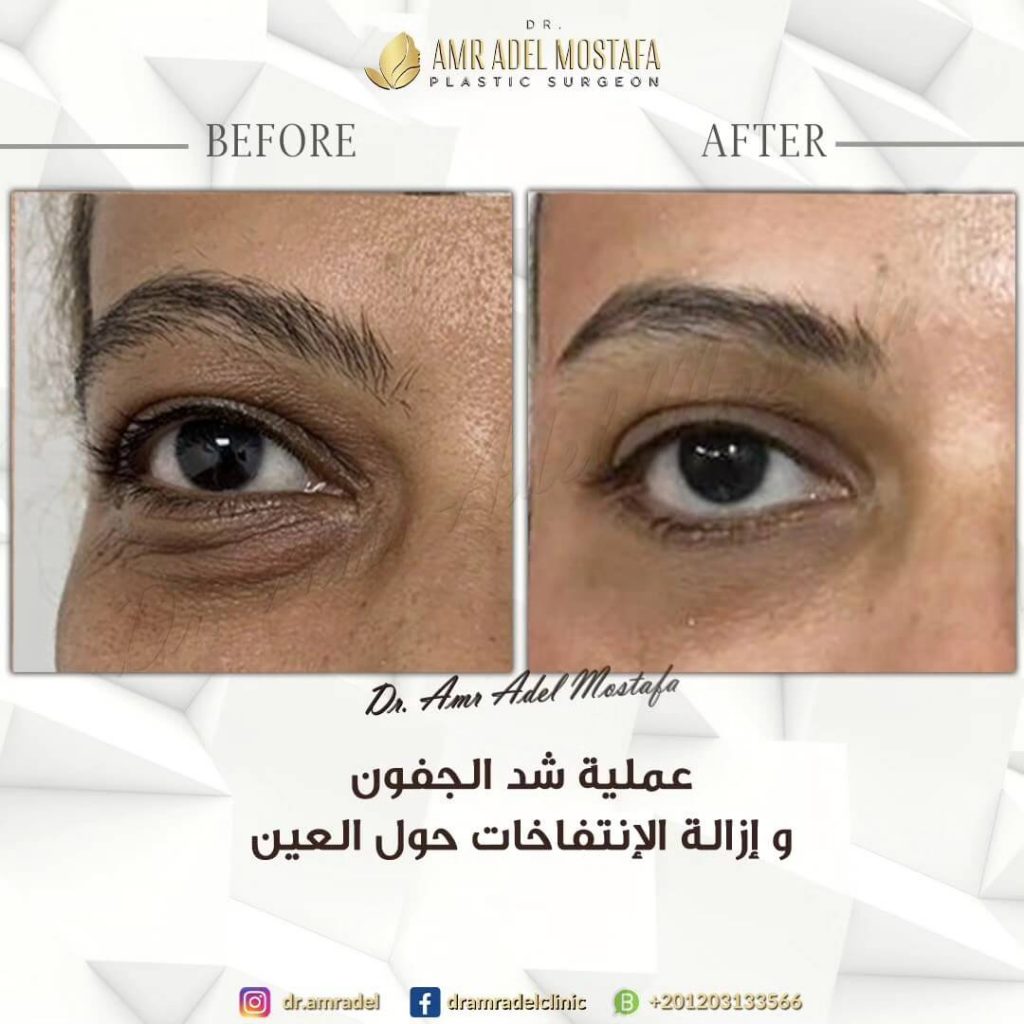 حالة-عملية-تجميل-الجفون