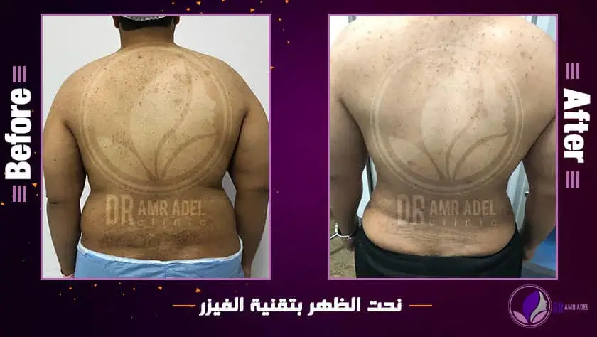 حالة-نجاح-نحت-الظهر