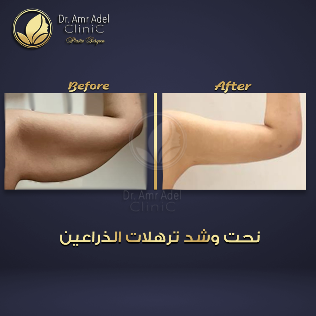 شد-الذراعين-جراحياً