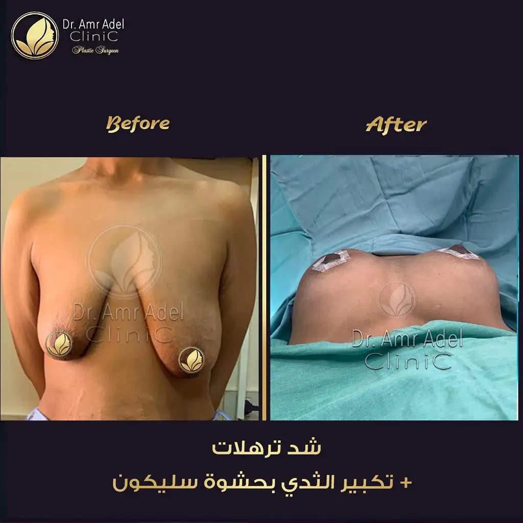 عملية-شد-ترهل-الثدى