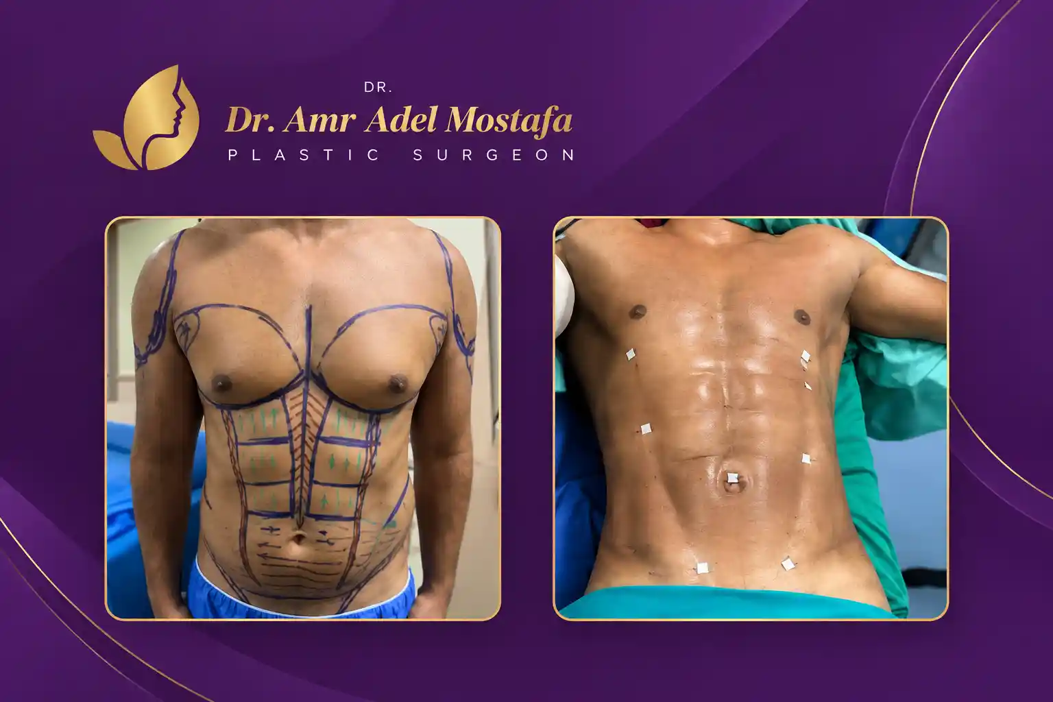 علاج التثدى
