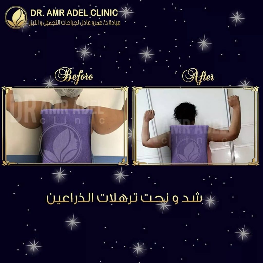 نحت-وشد-ترهلات-الذراعين