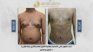تثدي-درجة-اولى