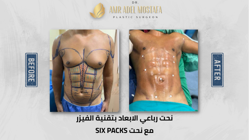 نحت رباعى الابعاد بتقنية الفيزر مع نحت six packs