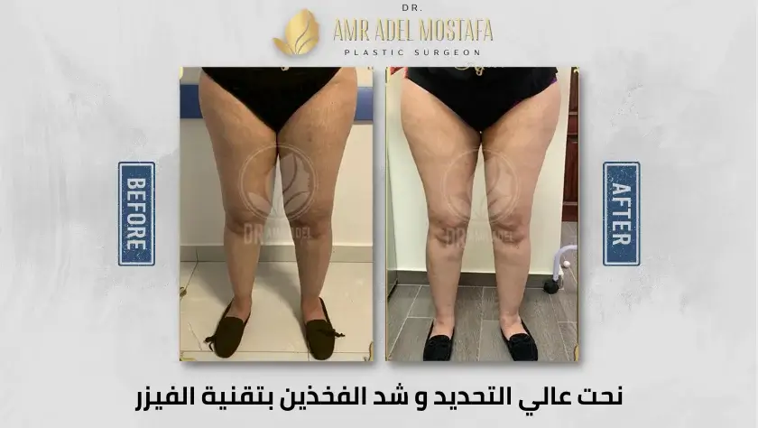 شد-الفخذين -بالفيزر