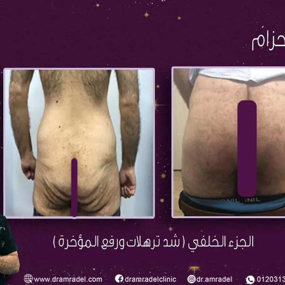 شد-ترهلات-المؤخرة