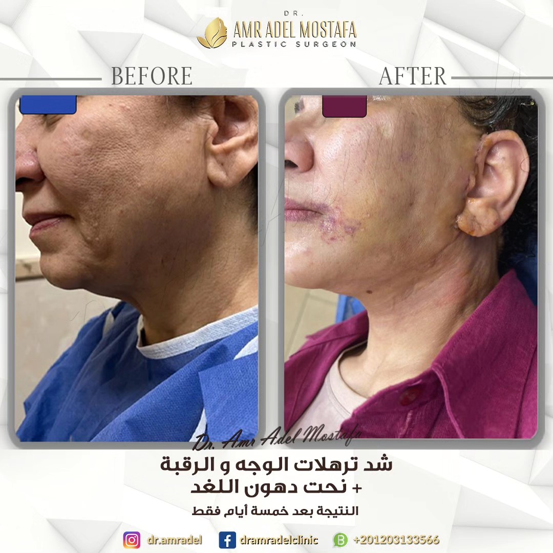 شد-ترهلات-الوجه-الرقبة