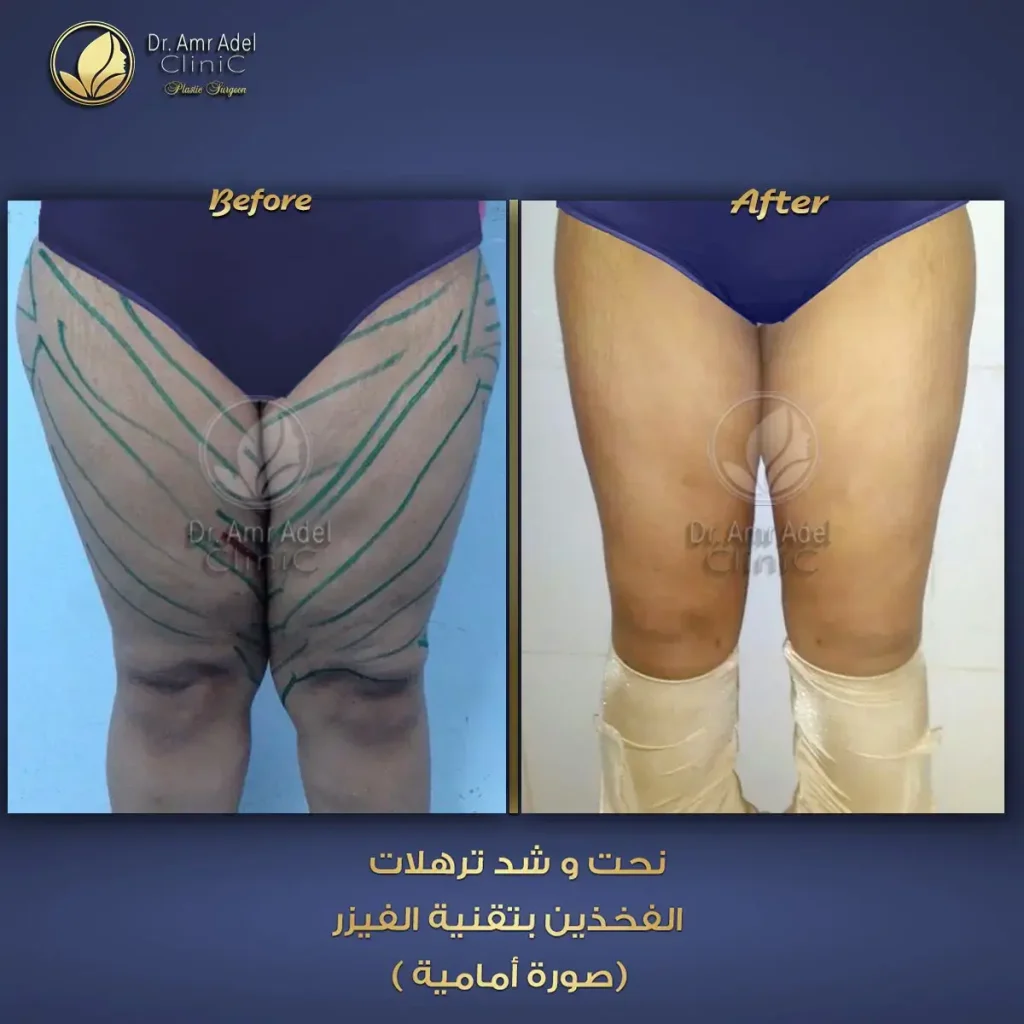 نحت-الفخذين-بالفيزر