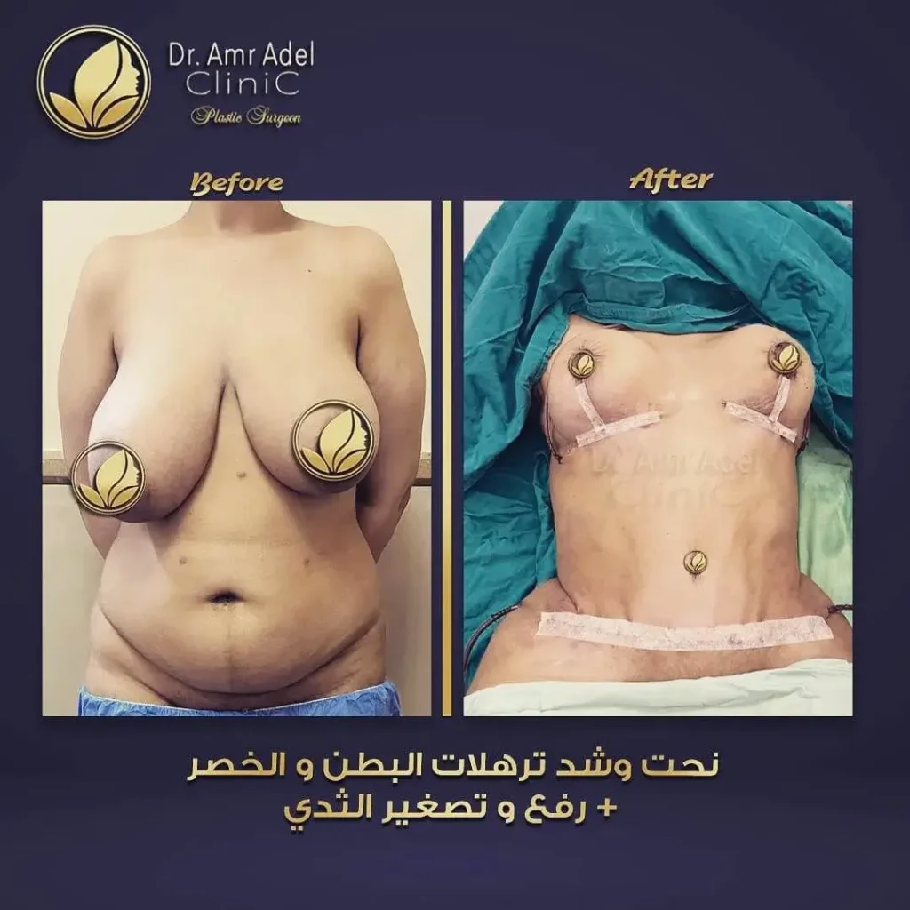 حالة-تصغير-الثدى