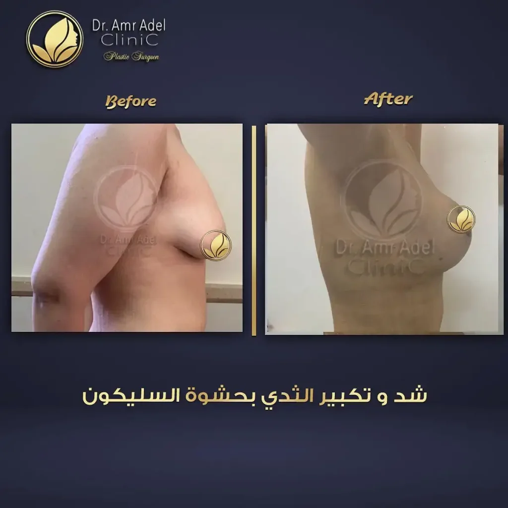 تكلفة-عملية-تكبير-الثدى