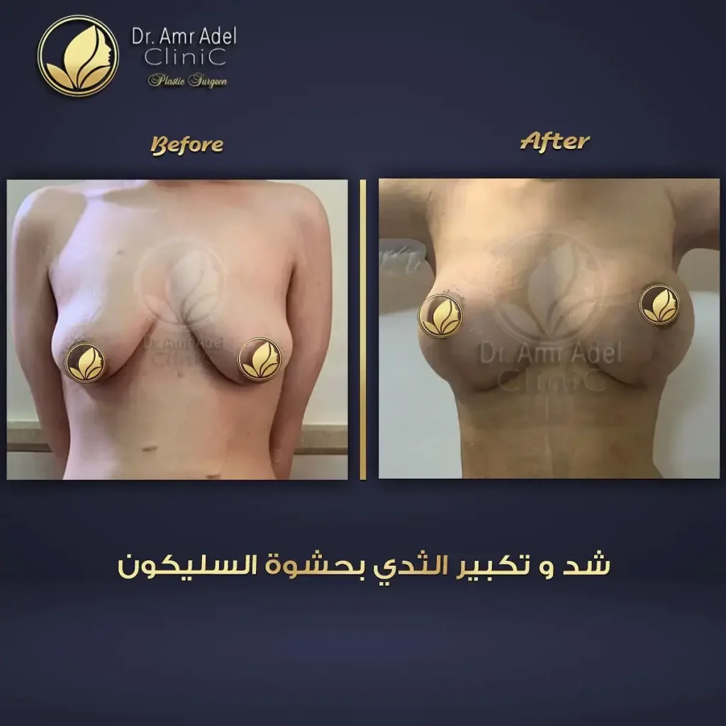 تكبير الثدي بدون جراحة