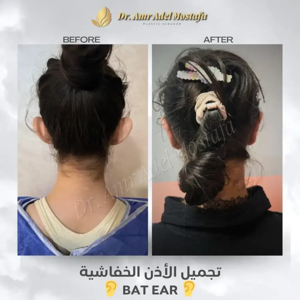 حالة-نجاح-الأذن-الخفاشية