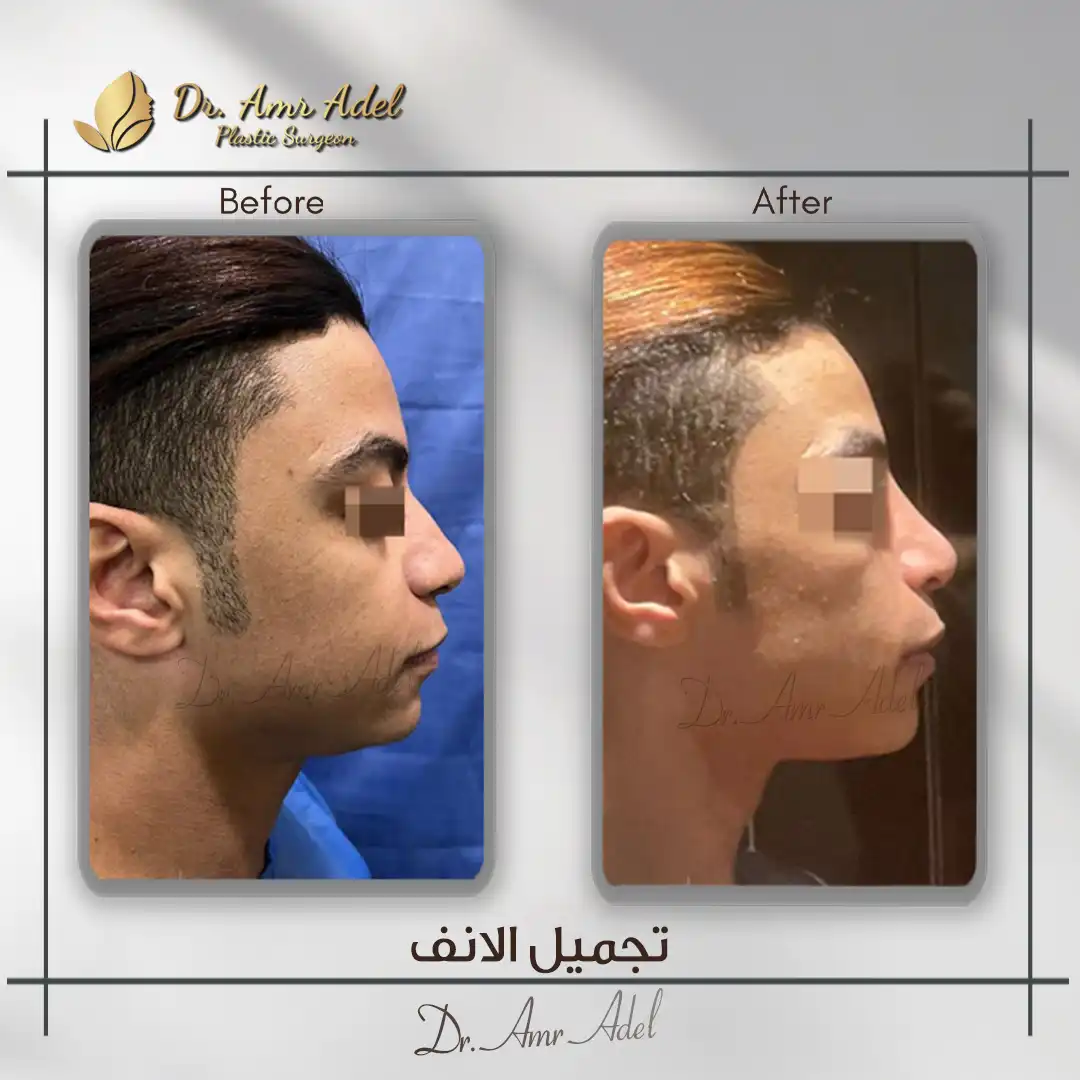 جراحة-تجميل-الأنف