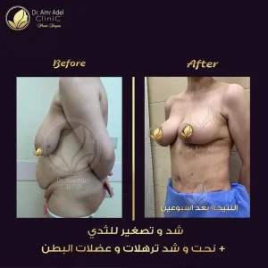 شد-وتصغير-الثدى
