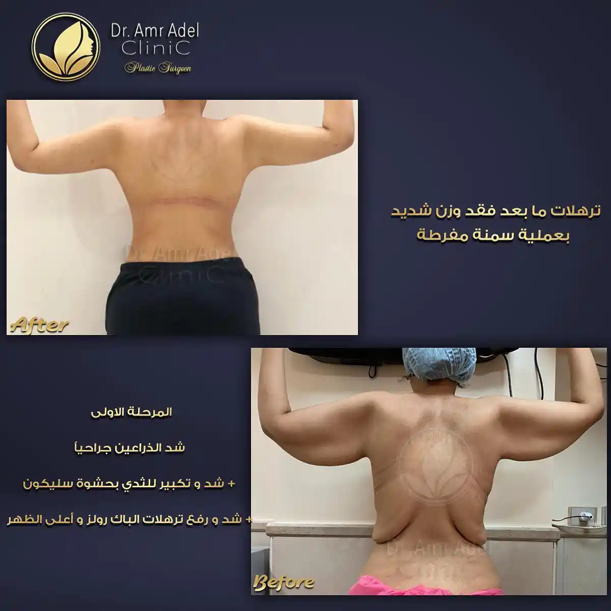 عملية-شد-ترهل-الجسم-بعد-التكميم