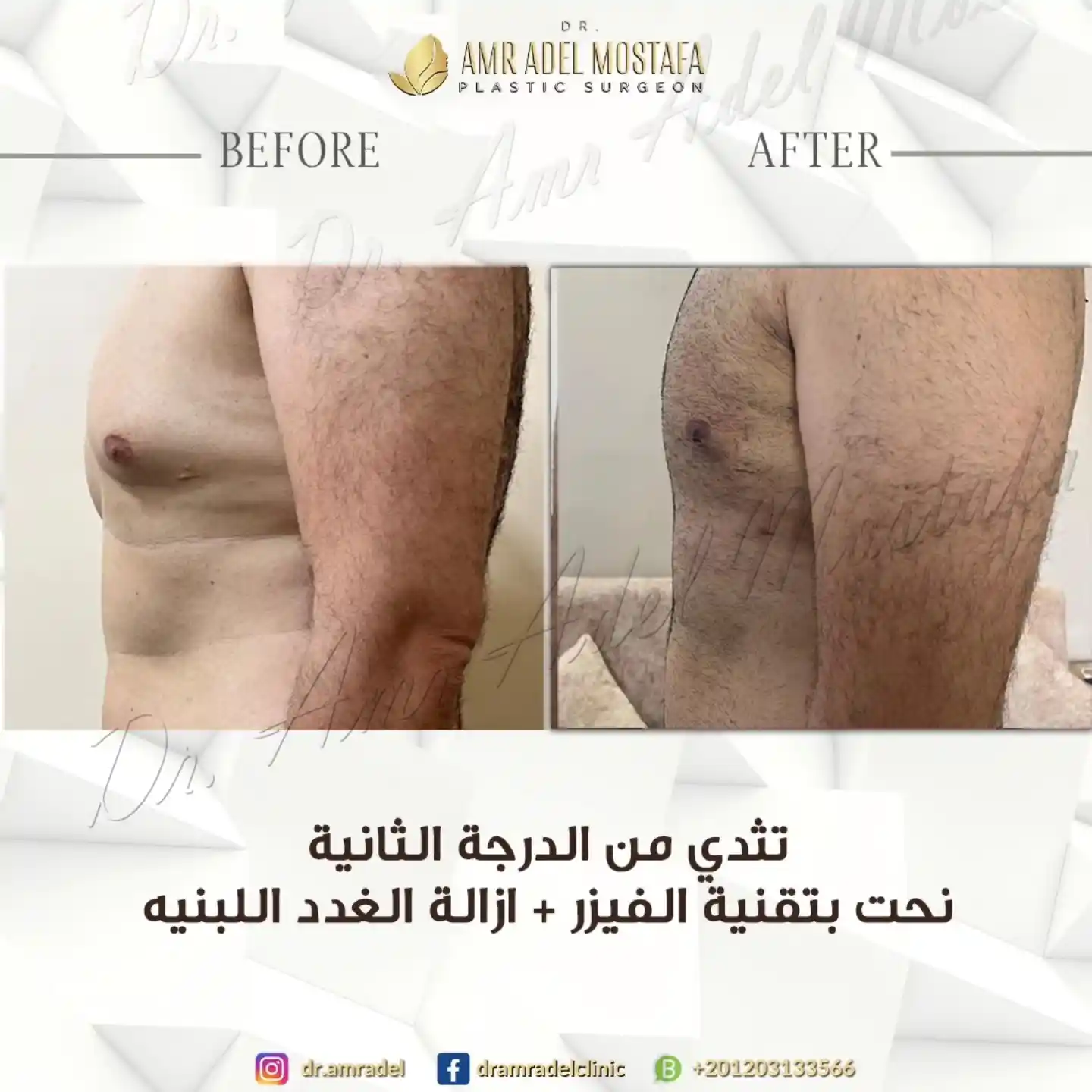 مريض-تثدى-درجة-ثانية