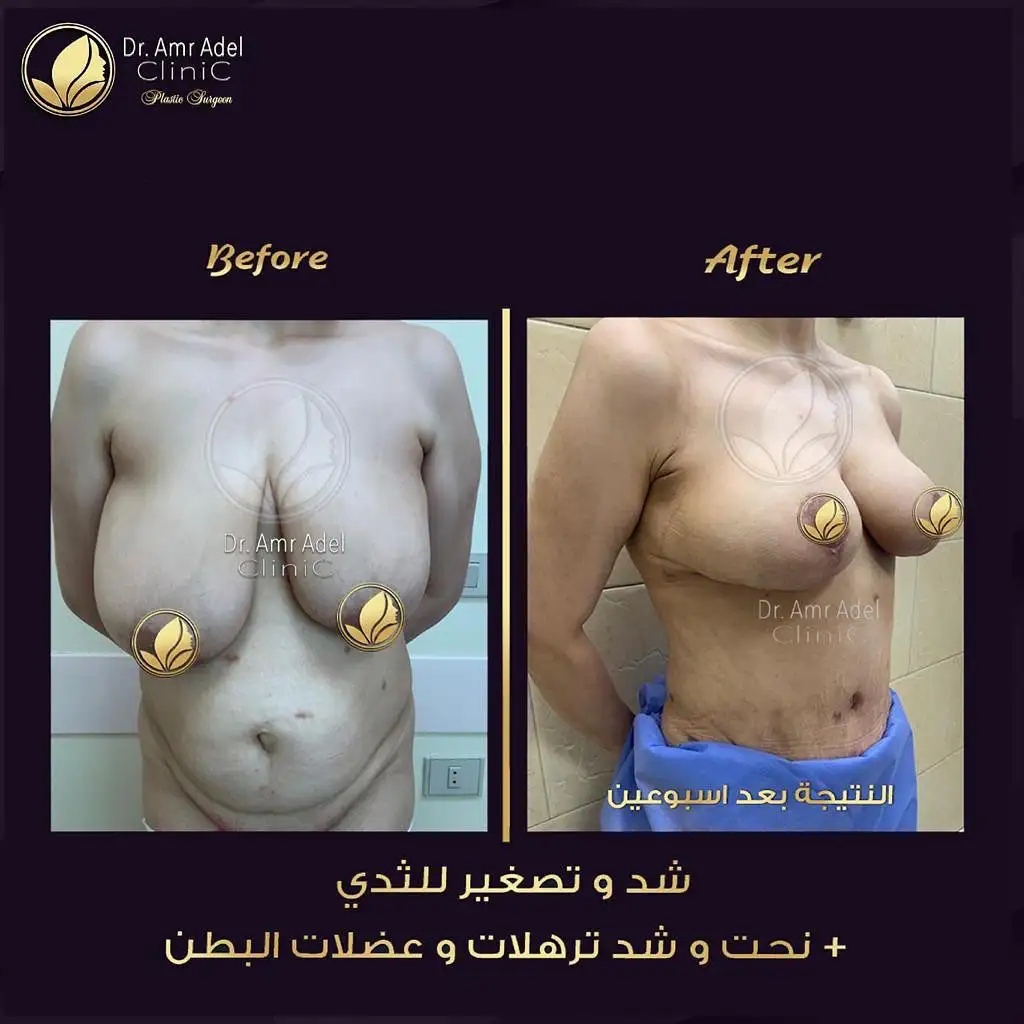 مميزات-تصغير-الثدى