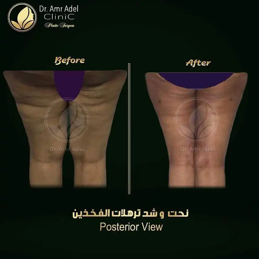 شفط-وشد-دهون-الفخذ