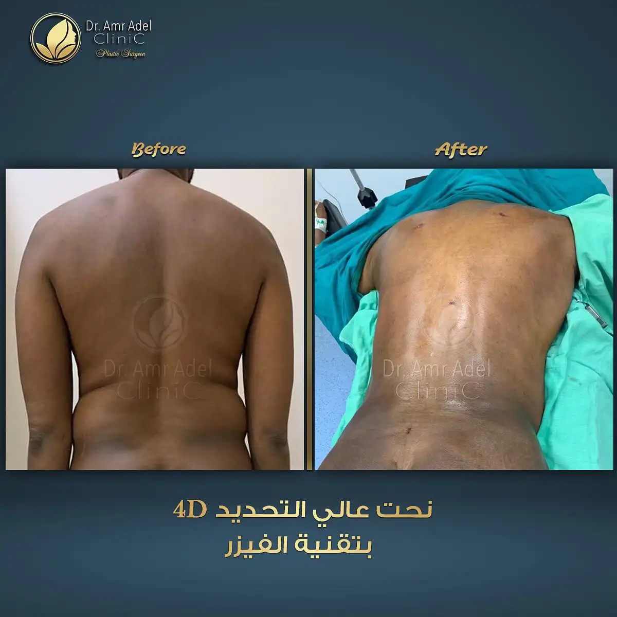 شفط-ونحت-بالفيزر