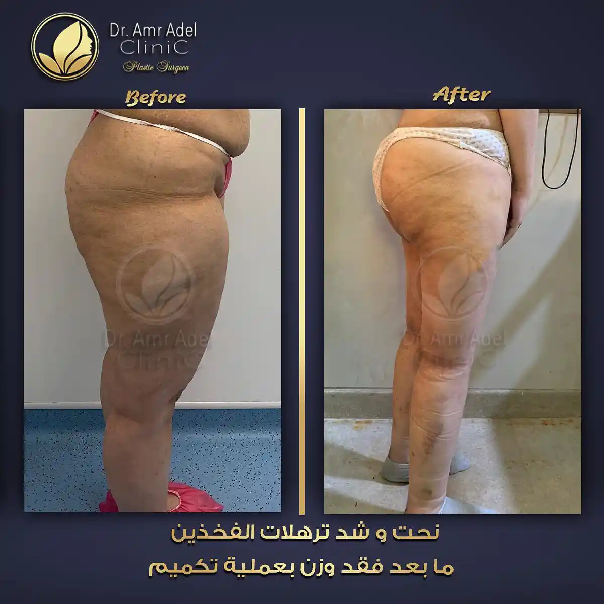 شفط-ونحت-دهون-الفخذين