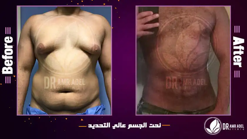 نحت-عالى-التحديد-بالفيزر