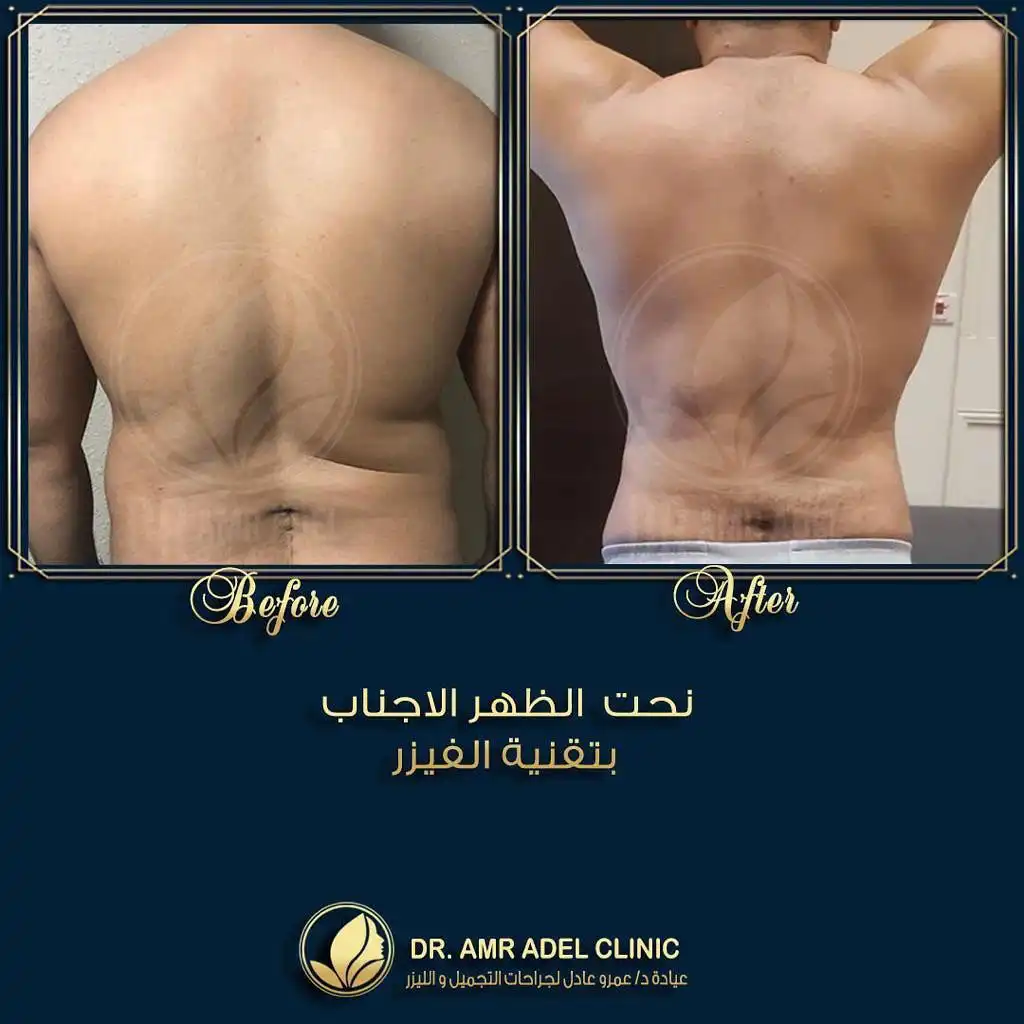 نحت-وشفط-الجسم-بالفيزر