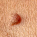 السنط-الجلدى