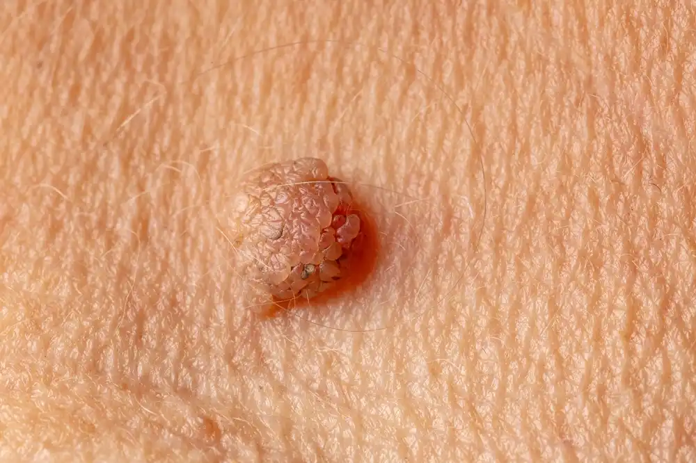 أحدث تقنيات علاج السنط الجلدي في مصر 2025