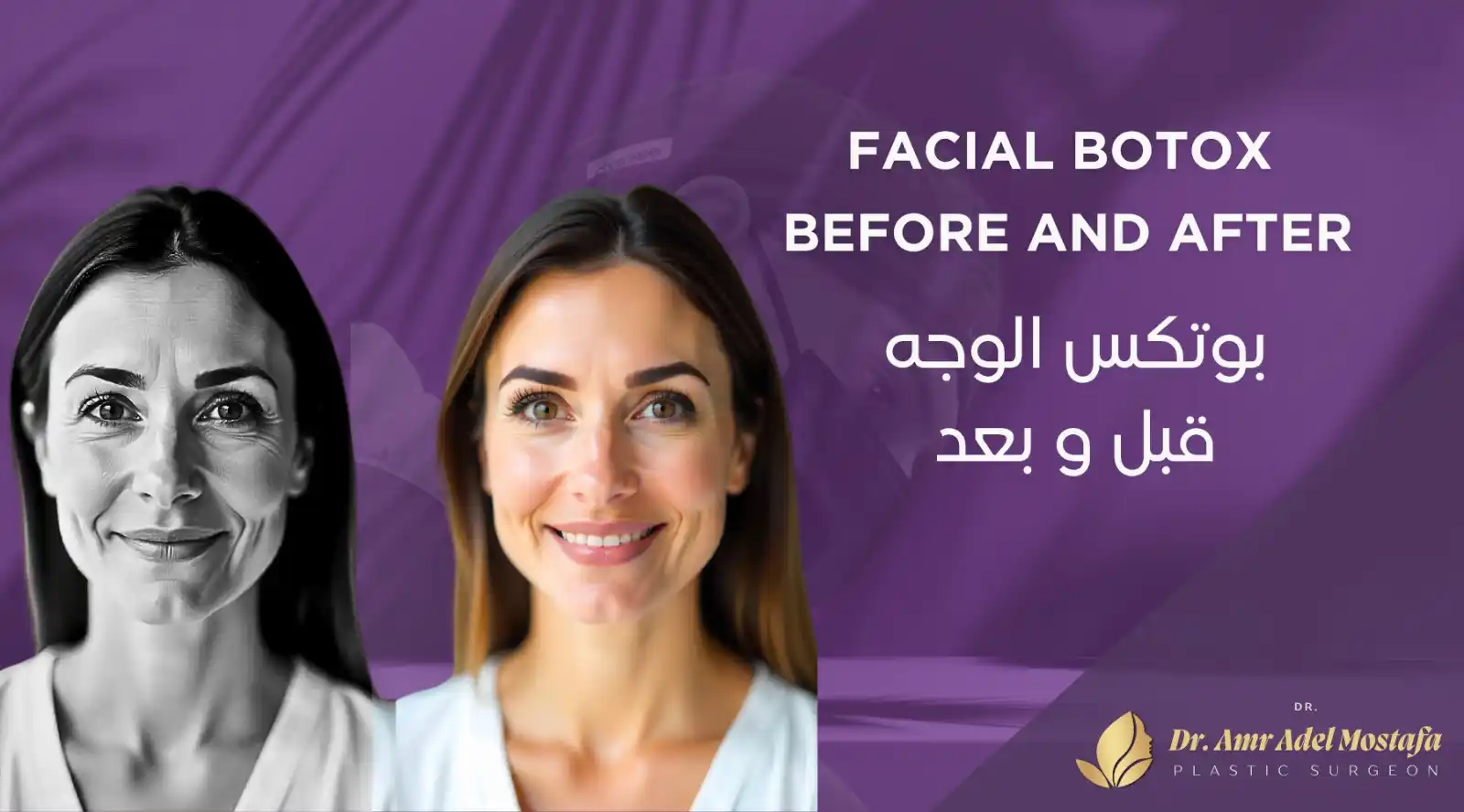 أهم الإجراءات التي يجب اتباعها قبل وبعد حقن الوجه بالبوتكس
