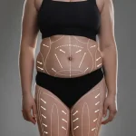 عملية-شفط-الدهون