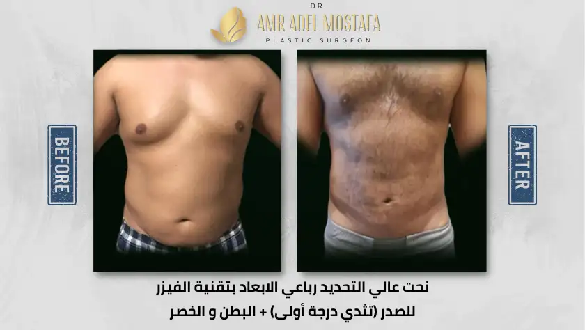 نحت-بالفيزر-لتثدى-درجة-اولى