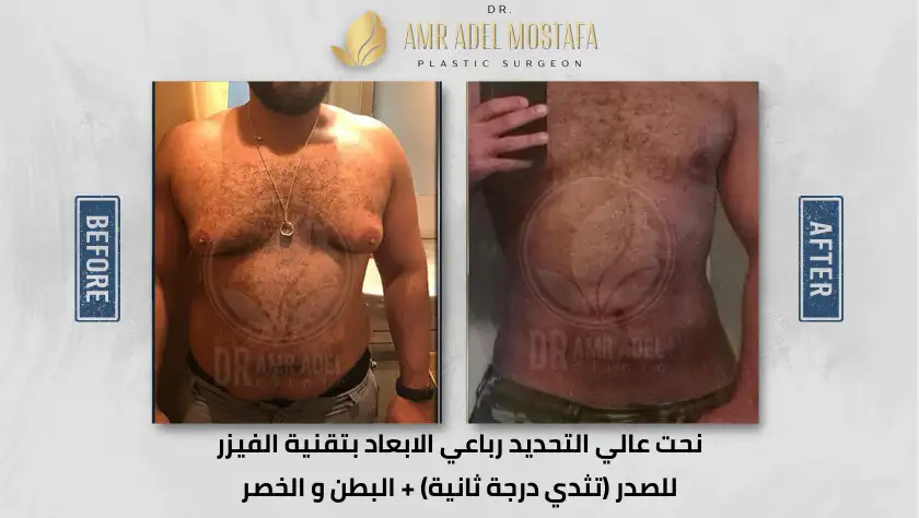 نحت-بالفيزر-للصدر