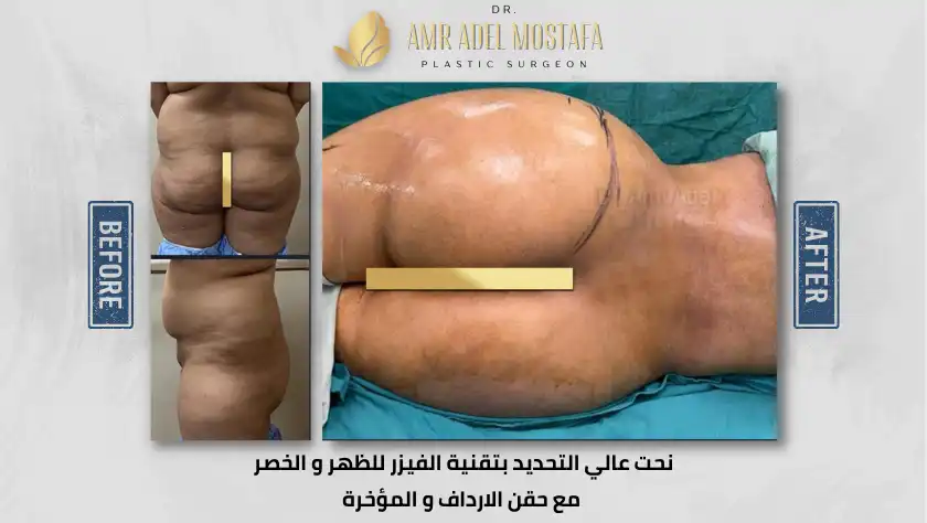 حقن-الارداف-والمؤخرة