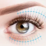 تجميل-الجفون-بالليزر