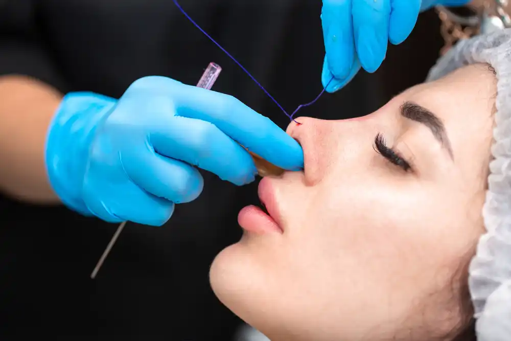 تكلفة-تجميل-الأنف-بالخيوط