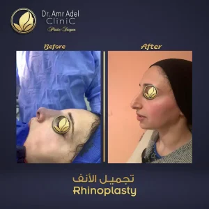 حالة-تجميل-أنف