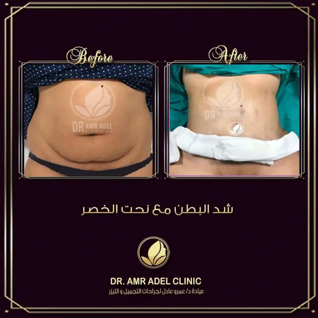 شفط-دهون -البطن