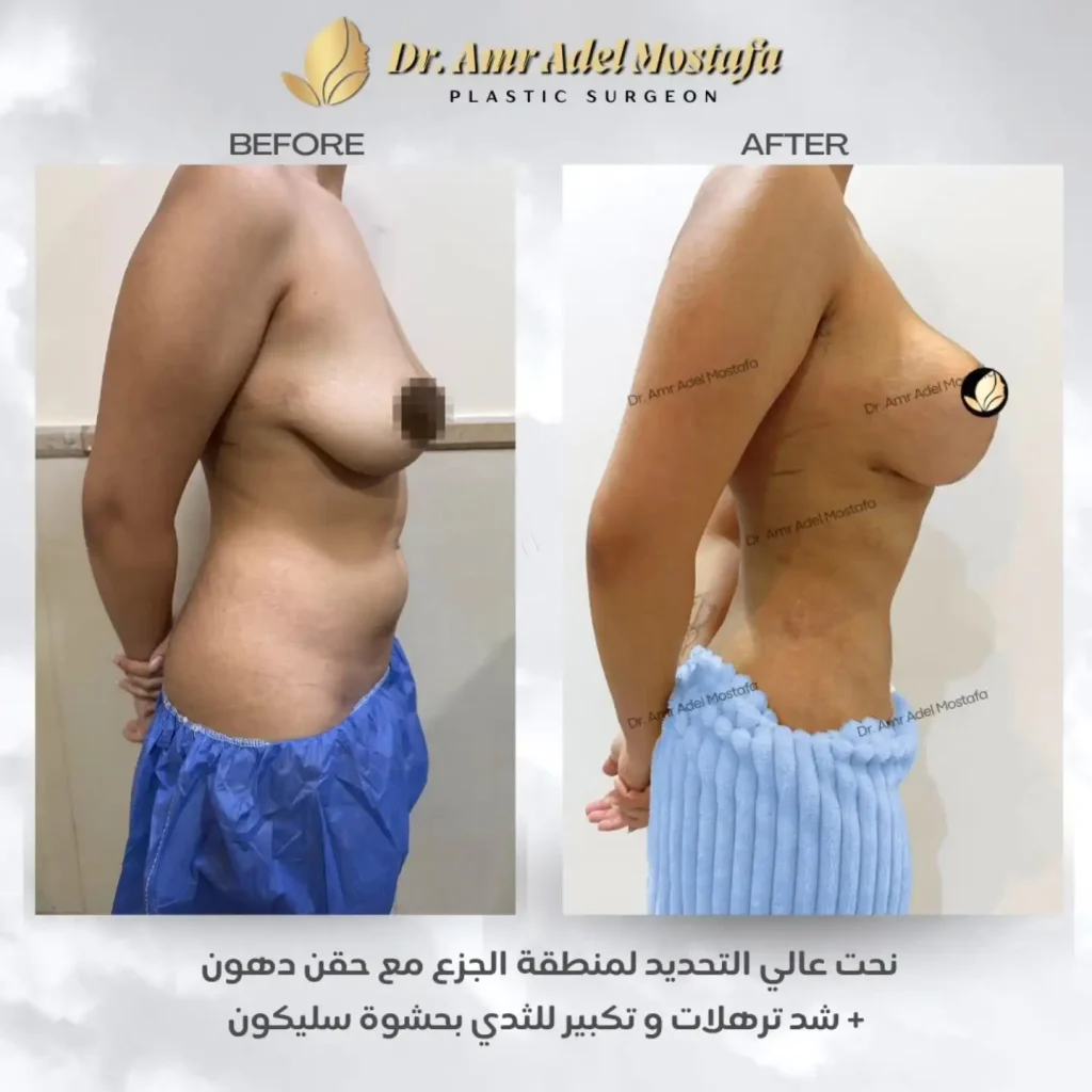 تكبير-الثدي-بالحشوات