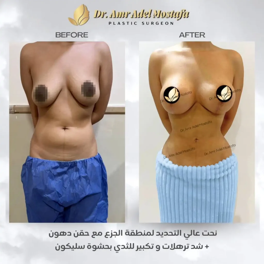 تكبير-الثدي-بحشوات-السيليكون