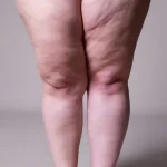 الوذمة-الشحمية