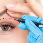 تجميل-الجفن-العلوي