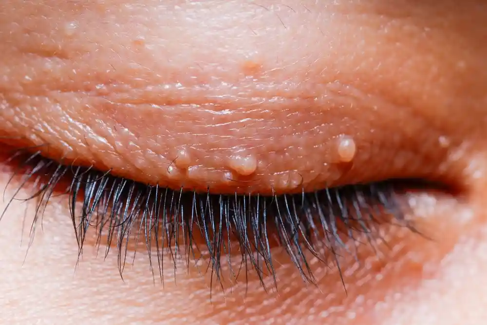 زوائد-جلدية-حول-العين