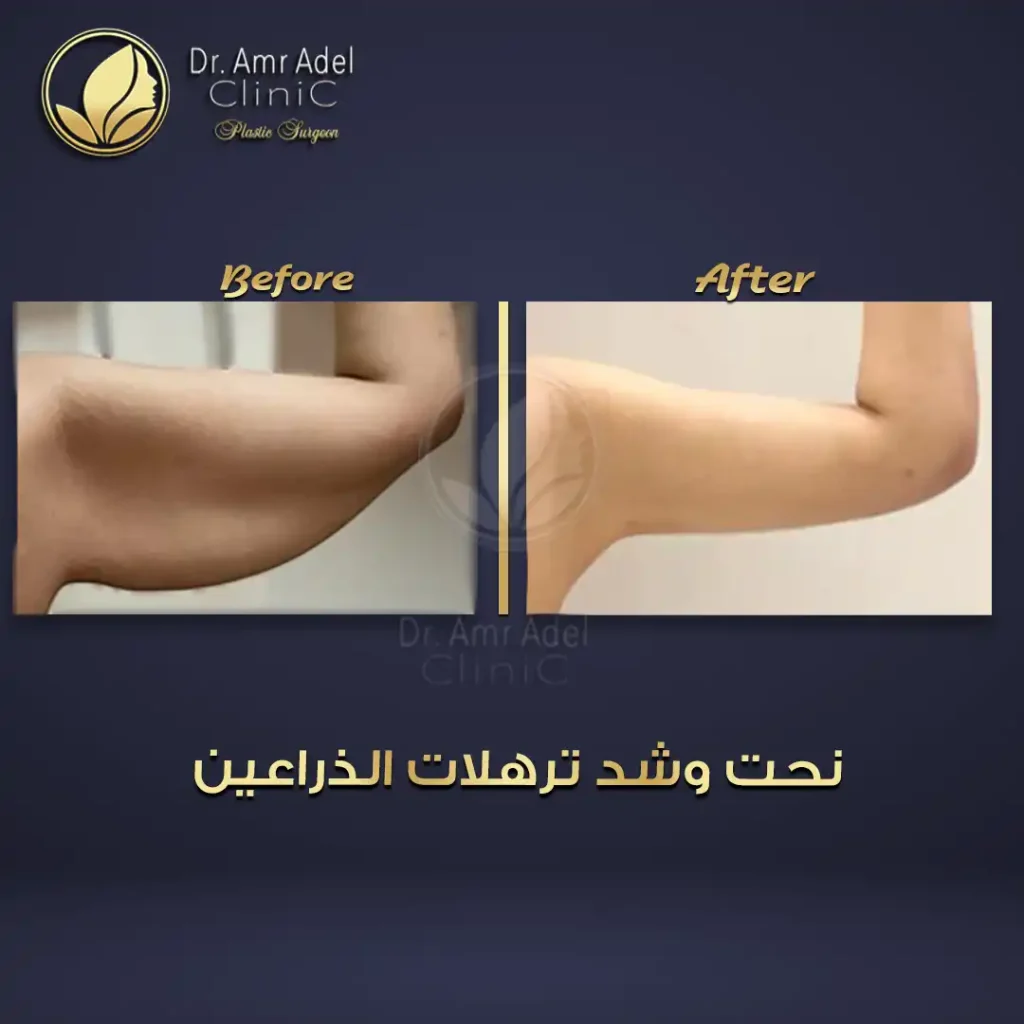 شد-ونحت-الذراعين