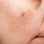 علاج-اثار-الجروح