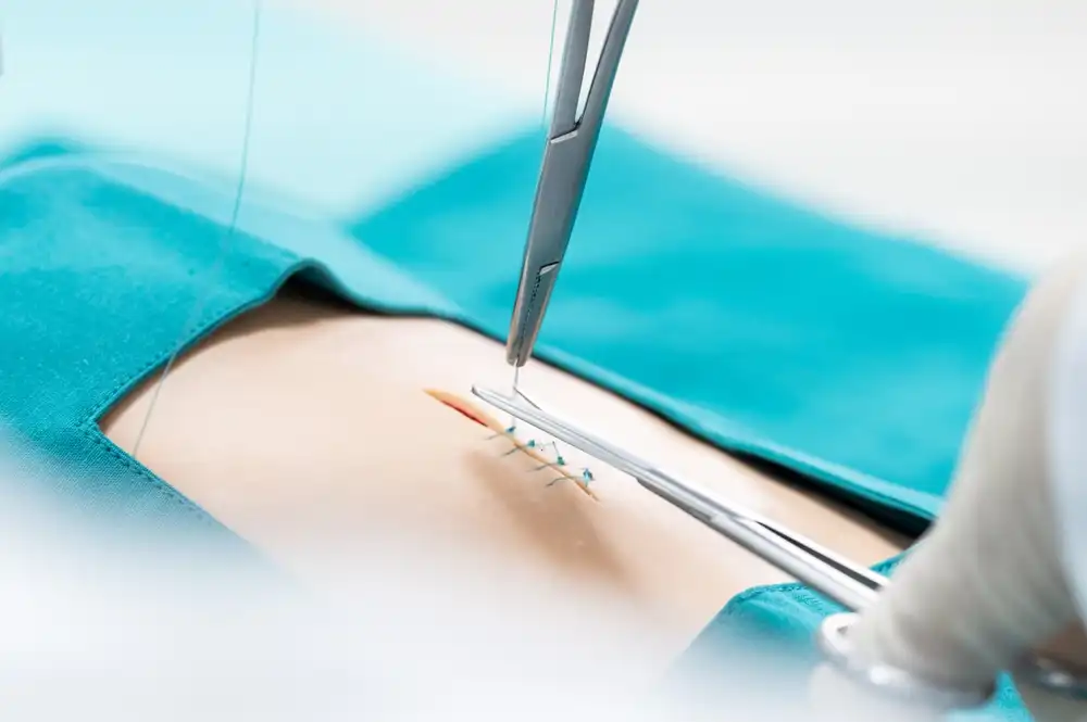 متى تحتاج إلى الخياطة التجميلية في الوجه وماهى أنواعها