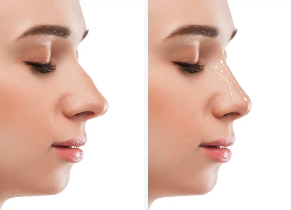 تجميل الانف اللحمي :وداعاً لمشاكل الانف العريض