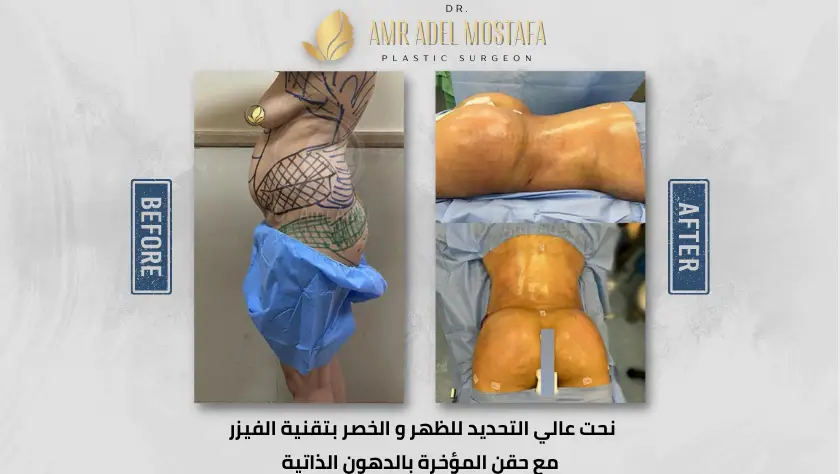 تكبير-المؤخرة-بالدهون